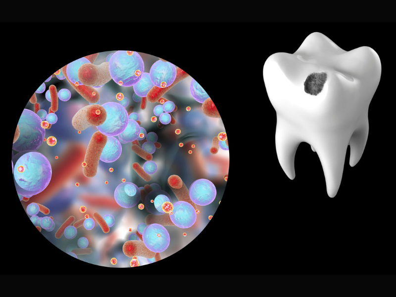 Carie dentale con i batteri del cavo orale