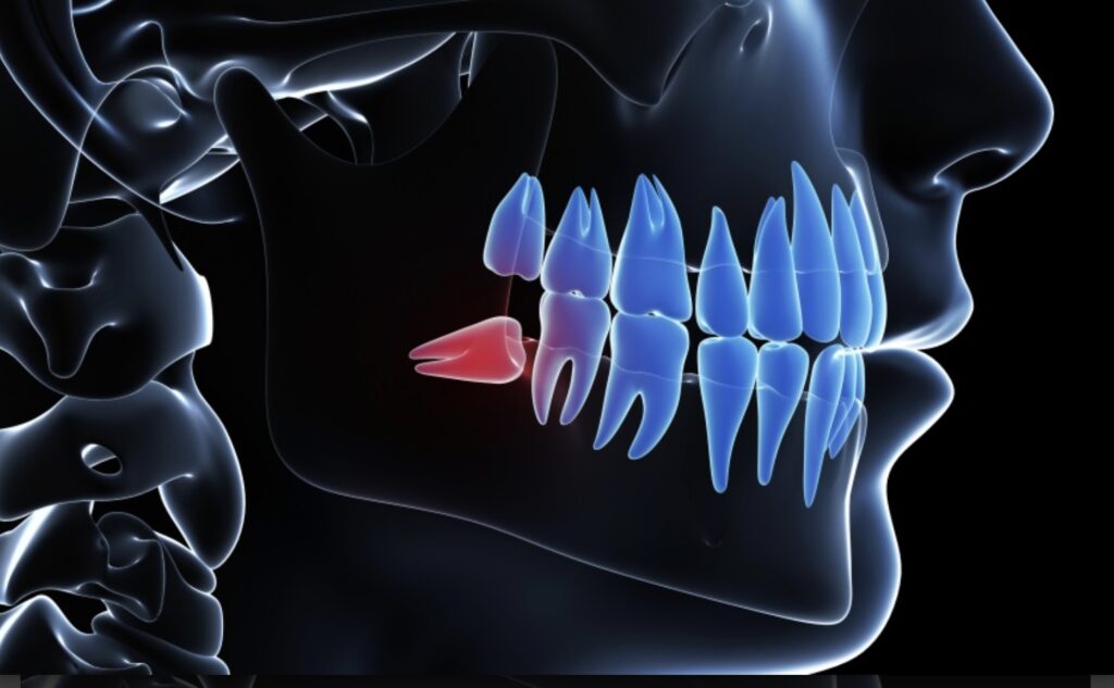 disegno di un profilo in trasparenza in cui si evidenziano i denti colorati in azzurro e in rosso i denti del giudizio
